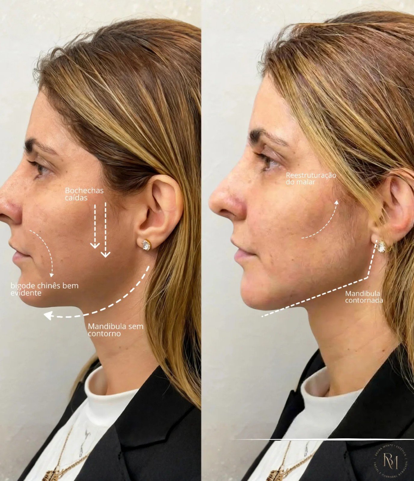 Contorno Mandibular — antes e depois