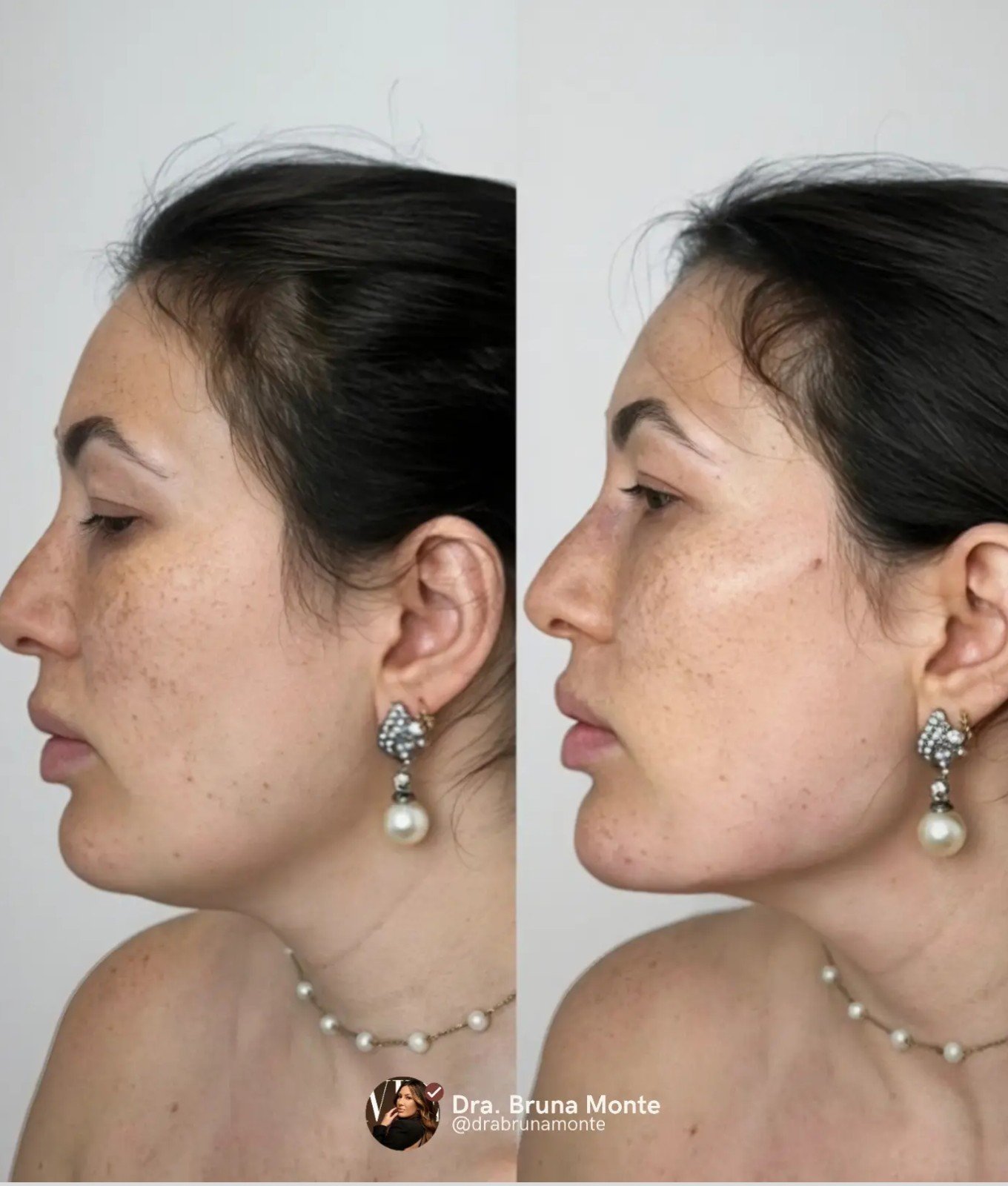 Harmonização Facial — antes e depois
