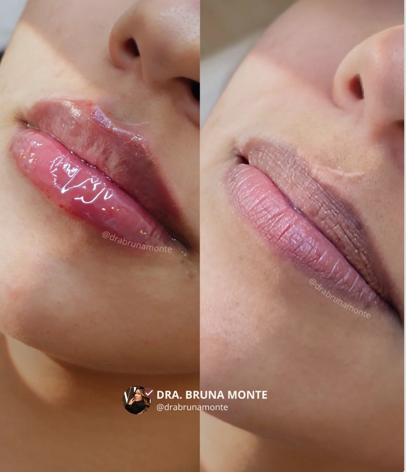 Preenchimento Labial — antes e depois