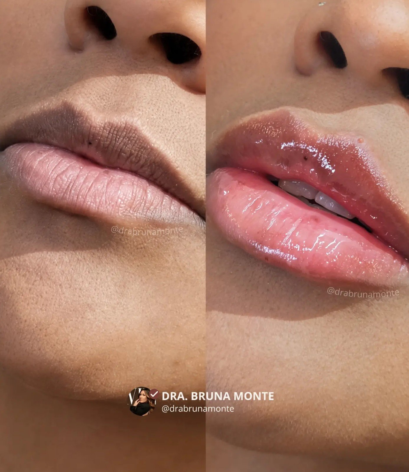 Preenchimento Labial — antes e depois